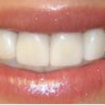 6 Dental Procedures That Will Improve Your Smile and Your Health